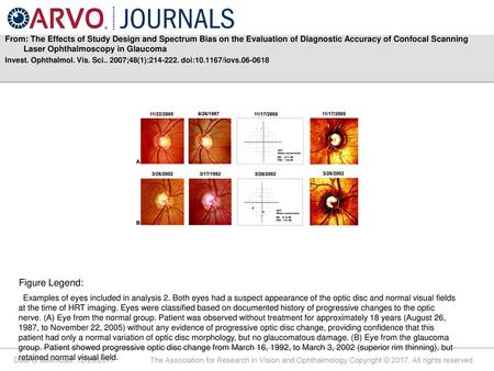 From: The Effects of Study Design and Spectrum Bias on the Evaluation of Diagnostic Accuracy of Confocal Scanning Laser Ophthalmoscopy in Glaucoma Invest.