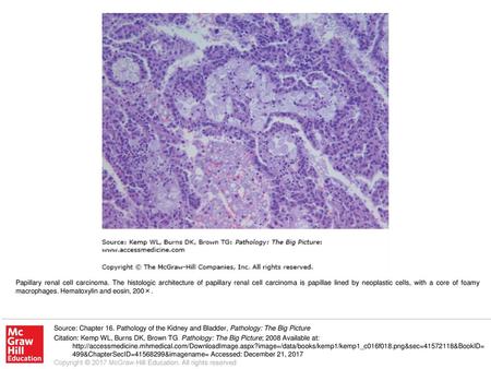 Papillary renal cell carcinoma