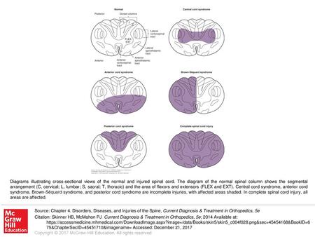 Diagrams illustrating cross-sectional views of the normal and injured spinal cord. The diagram of the normal spinal column shows the segmental arrangement.