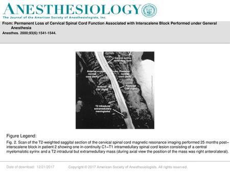 From: Permanent Loss of Cervical Spinal Cord Function Associated with Interscalene Block Performed under General Anesthesia Anesthes. 2000;93(6):1541-1544.