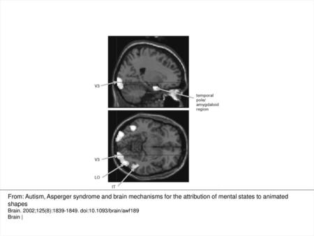 Fig. 1 Greater activation in occipital and temporal pole/amygdaloid regions while watching ToM animations (top: sagittal view; bottom: horizontal view).