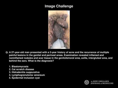 Image Challenge Q: A 27-year-old man presented with a 2-year history of acne and the recurrence of multiple painful lesions in the genital and perineal.