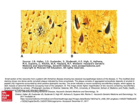 Small section of the neocortex from a patient with Alzheimer disease showing two classical neuropathologic lesions of the disease. A. The modified silver.