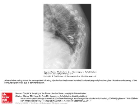 A lateral view radiograph of the same patient following injection into the involved vertebral bodies of polymethyl methacrylate. Note the radiolucency.