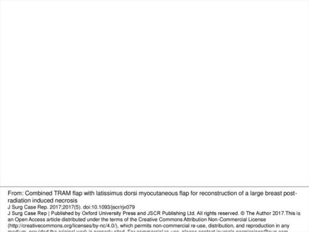 Figure 1: (A, frontal) and (B, lateral) Final result, 4 months post-operative, after right breast reconstruction using combined TRAM flap and LDMF. From: