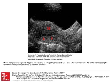 Myoma. Longitudinal sonogram of the pelvis demonstrating an enlarged myomatous uterus. A large anterior uterine myoma (M) can be seen displacing the endometrial.