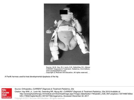 A Pavlik harness used to treat developmental dysplasia of the hip.