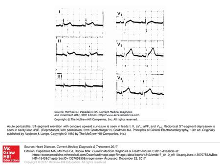 Acute pericarditis. ST-segment elevation with concave upward curvature is seen in leads I, II, aVL, aVF, and V2-6. Reciprocal ST-segment depression is.