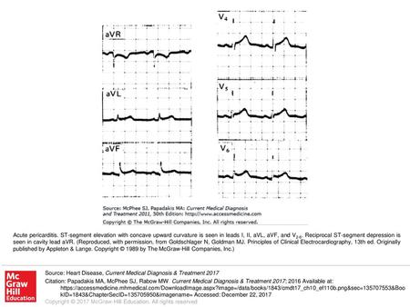 Acute pericarditis. ST-segment elevation with concave upward curvature is seen in leads I, II, aVL, aVF, and V2-6. Reciprocal ST-segment depression is.