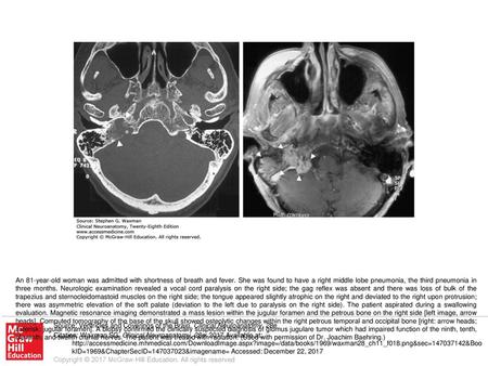 An 81-year-old woman was admitted with shortness of breath and fever