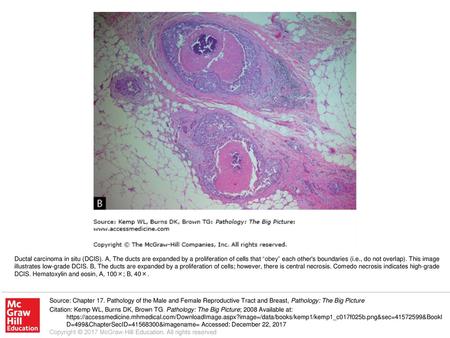 Ductal carcinoma in situ (DCIS)