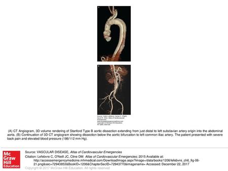 (A) CT Angiogram, 3D volume rendering of Stanford Type B aortic dissection extending from just distal to left subclavian artery origin into the abdominal.