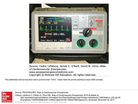 This defibrillator device has been set to synchronized “SYNC” mode