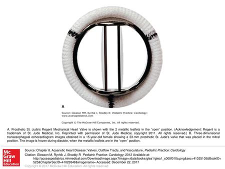 A. Prosthetic St. Jude's Regent Mechanical Heart Valve is shown with the 2 metallic leaflets in the “open” position. (Acknowledgement: Regent is a trademark.