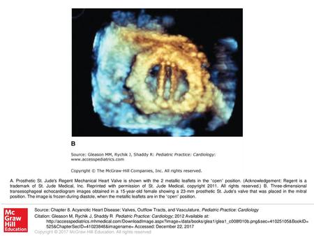 A. Prosthetic St. Jude's Regent Mechanical Heart Valve is shown with the 2 metallic leaflets in the “open” position. (Acknowledgement: Regent is a trademark.