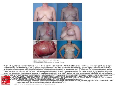 Delayed-delayed breast reconstruction in a 45-year old female who presented with a T2N3M0 left breast cancer who was known preoperatively to require postmastectomy.