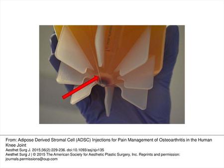 Figure 1. GID SVF-1 device (Louisville, CO) with concentrated cell pellet. From: Adipose Derived Stromal Cell (ADSC) Injections for Pain Management of.