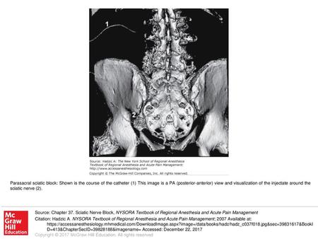 Parasacral sciatic block: Shown is the course of the catheter (1) This image is a PA (posterior-anterior) view and visualization of the injectate around.