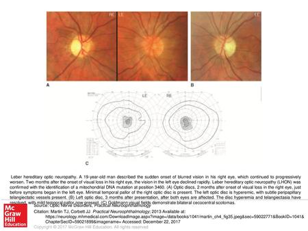 Leber hereditary optic neuropathy