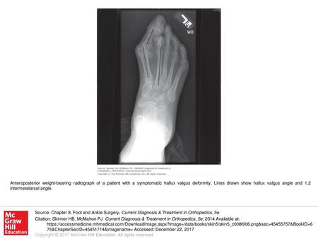 Anteroposterior weight-bearing radiograph of a patient with a symptomatic hallux valgus deformity. Lines drawn show hallux valgus angle and 1,2 intermetatarsal.