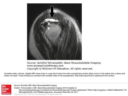 Complete rotator cuff tear