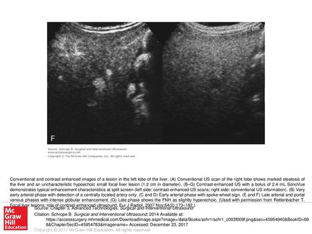 Conventional and contrast enhanced images of a lesion in the left lobe of the liver. (A) Conventional US scan of the right lobe shows marked steatosis.