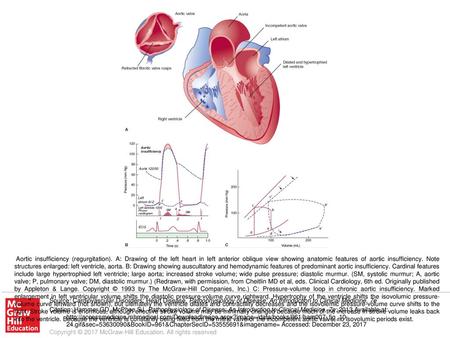 Aortic insufficiency (regurgitation)