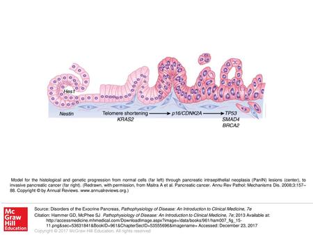 Model for the histological and genetic progression from normal cells (far left) through pancreatic intraepithelial neoplasia (PanIN) lesions (center),