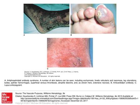 A. Antiphospholipid antibody syndrome