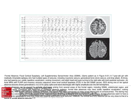 Secondarily generalized discharges are a common occurrence with frontal lobe epilepsy. The EEG findings that suggest secondary bilateral synchrony include.