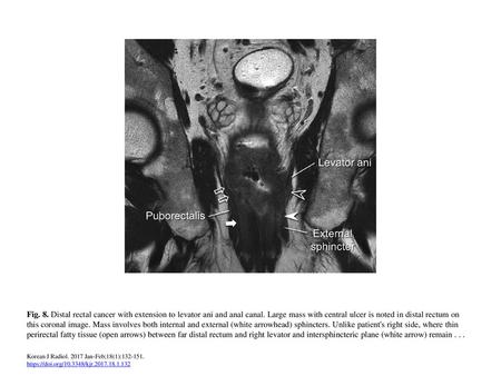 Fig. 8. Distal rectal cancer with extension to levator ani and anal canal. Large mass with central ulcer is noted in distal rectum on this coronal image.