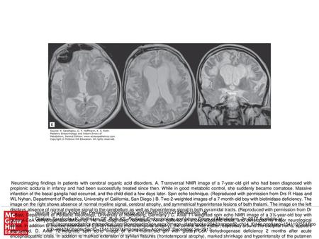 Neuroimaging findings in patients with cerebral organic acid disorders