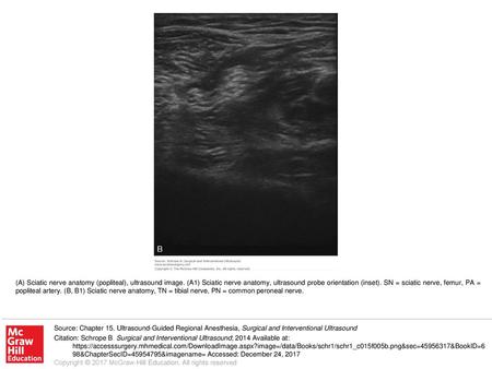 (A) Sciatic nerve anatomy (popliteal), ultrasound image