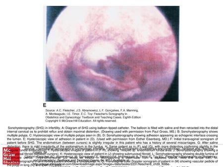 Sonohysterography (SHG) in infertility