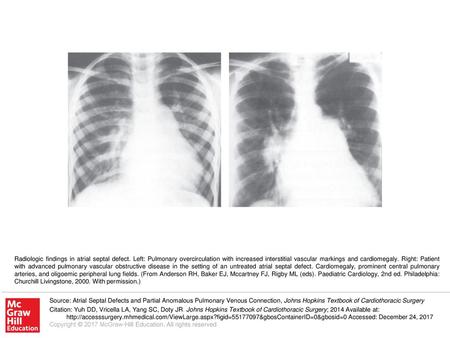 Radiologic findings in atrial septal defect