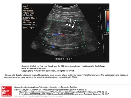 Coronal color Doppler ultrasound image of the posterior chest showing a large multicystic mass in the left lung (arrows). The aorta is seen, and it does.