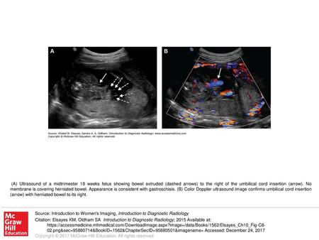 (A) Ultrasound of a midtrimester 18 weeks fetus showing bowel extruded (dashed arrows) to the right of the umbilical cord insertion (arrow). No membrane.