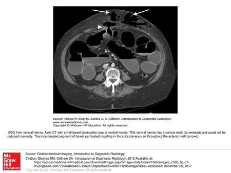 SBO from ventral hernia