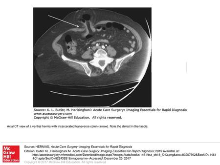 Axial CT view of a ventral hernia with incarcerated transverse colon (arrow). Note the defect in the fascia. Source: HERNIAS, Acute Care Surgery: Imaging.