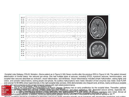 POLG1 mutations should be considered in teenagers and young adults reporting episodic visual symptoms with migraine-like headaches and sudden-onset intractable.