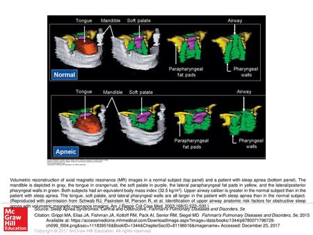 Volumetric reconstruction of axial magnetic resonance (MR) images in a normal subject (top panel) and a patient with sleep apnea (bottom panel). The mandible.