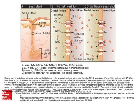 Mechanism of underlying elevated sodium chloride levels in the sweat of patients with cystic fibrosis (CF). Sweat ducts (Panel A) in patients with CF differ.