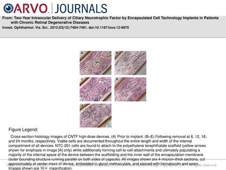 From: Two-Year Intraocular Delivery of Ciliary Neurotrophic Factor by Encapsulated Cell Technology Implants in Patients with Chronic Retinal Degenerative.