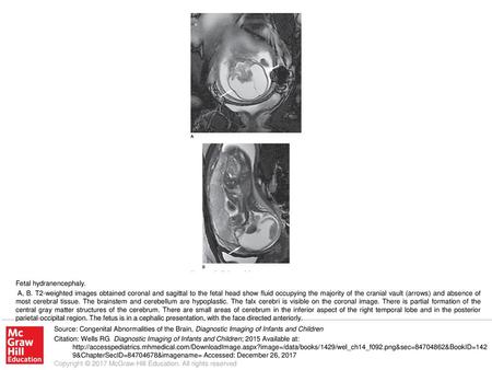 A, B. T2-weighted images obtained coronal and sagittal to the fetal head show fluid occupying the majority of the cranial vault (arrows) and absence of.