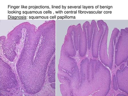 Finger like projections, lined by several layers of benign looking squamous cells , with central fibrovascular core Diagnosis: squamous cell papilloma.