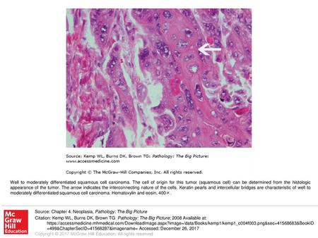 Well to moderately differentiated squamous cell carcinoma