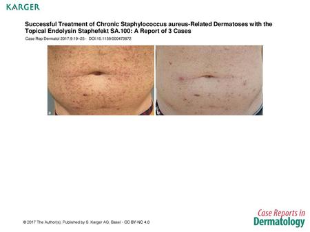 Successful Treatment of Chronic Staphylococcus aureus-Related Dermatoses with the Topical Endolysin Staphefekt SA.100: A Report of 3 Cases Case Rep Dermatol.