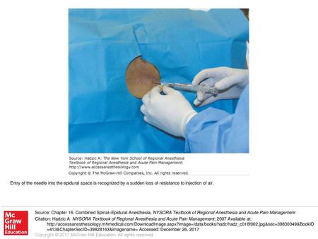 Entry of the needle into the epidural space is recognized by a sudden loss of resistance to injection of air. Source: Chapter 16. Combined Spinal–Epidural.