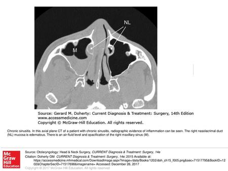 Chronic sinusitis. In this axial plane CT of a patient with chronic sinusitis, radiographic evidence of inflammation can be seen. The right nasolacrimal.