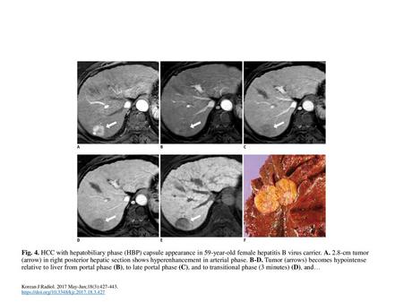 Fig. 4. HCC with hepatobiliary phase (HBP) capsule appearance in 59-year-old female hepatitis B virus carrier. A. 2.8-cm tumor (arrow) in right posterior.